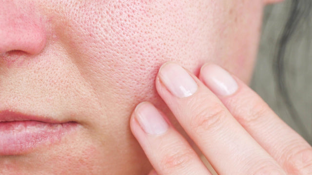 How to (Correctly!) Unclog Your Pores