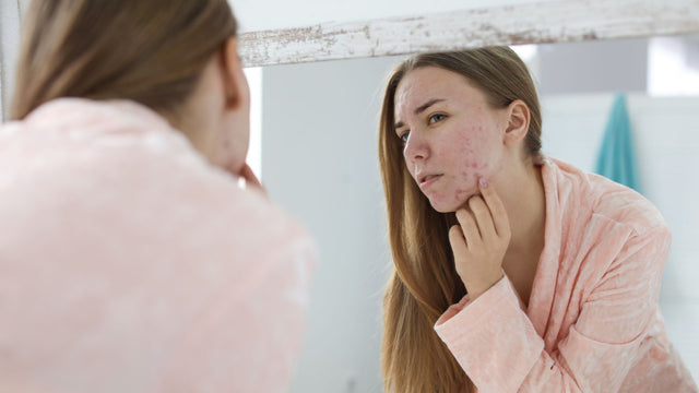 How to Use Salicylic Acid to Effectively Treat Acne