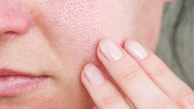 How to  (Correctly!) Unclog Your Pores