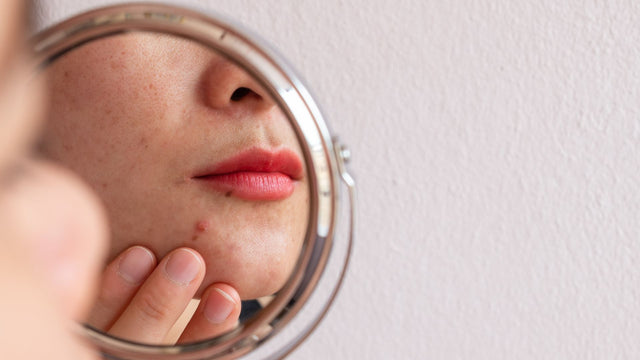 Retinol and Acne-Prone Skin: What's the Deal?